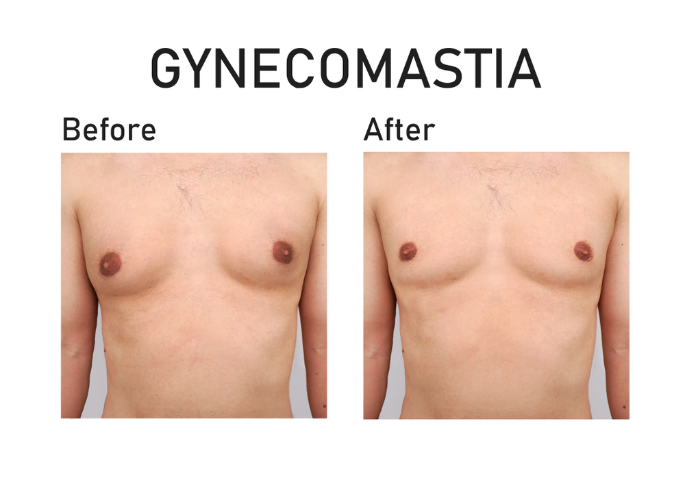 Male Breast Reduction Surgery